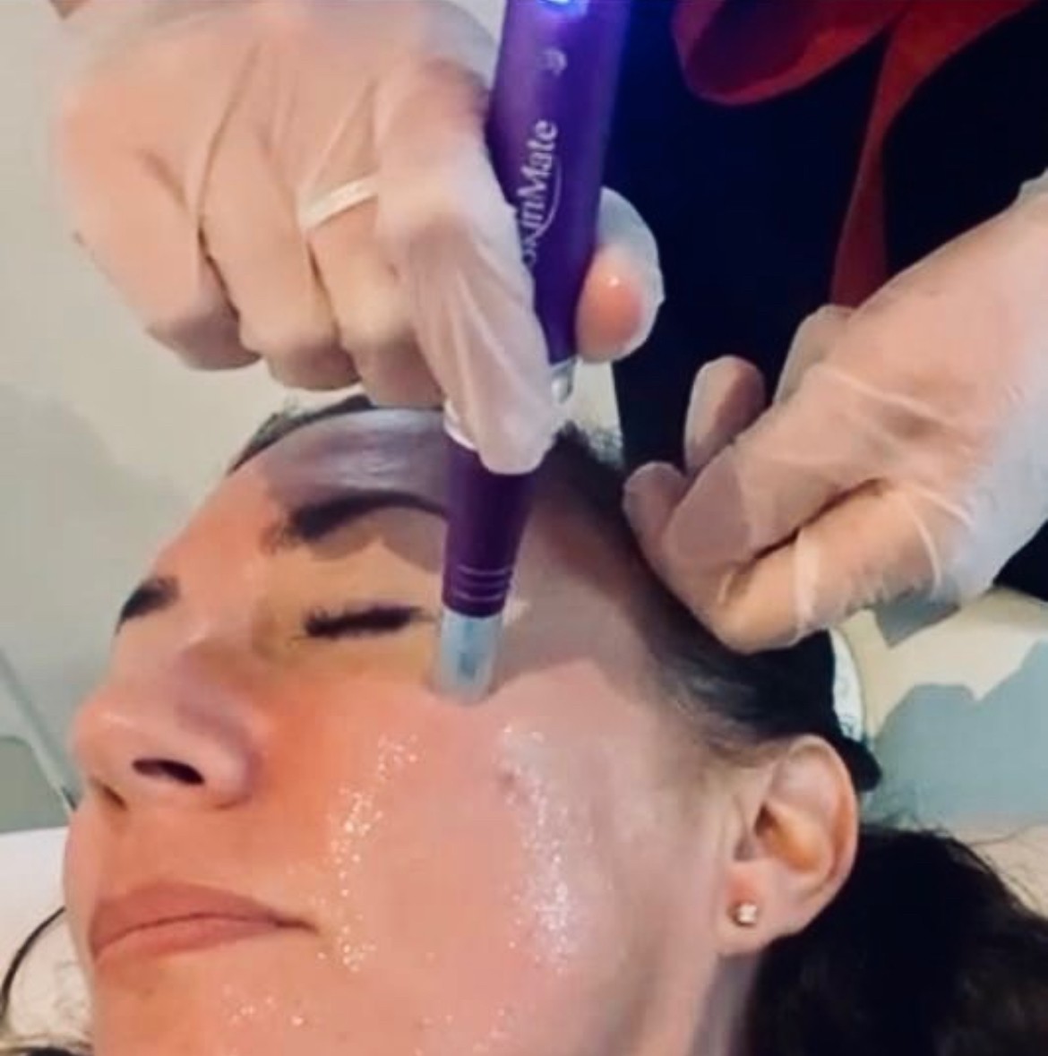 MICRONEEDLING